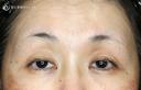 【50代女性・ハードコンタクトレンズ眼瞼下垂】切らない眼瞼下垂+α法（術直後〜1ヶ月後） before画像 サムネイル用