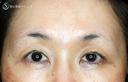 【50代女性・ハードコンタクトレンズ眼瞼下垂】切らない眼瞼下垂+α法（術直後〜1ヶ月後） 30日後 サムネイル用