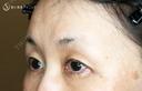 【50代女性・ハードコンタクトレンズ眼瞼下垂】切らない眼瞼下垂+α法（術直後〜1ヶ月後） 30日後 サムネイル用