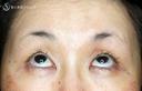 【50代女性・ハードコンタクトレンズ眼瞼下垂】切らない眼瞼下垂+α法（術直後〜1ヶ月後） 30日後 サムネイル用