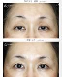 【50代女性・ハードコンタクトレンズ眼瞼下垂】切らない眼瞼下垂+α法（術直後〜1ヶ月後） 30日後 サムネイル用