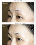 【50代女性・ハードコンタクトレンズ眼瞼下垂】切らない眼瞼下垂+α法（術直後〜1ヶ月後） 30日後 サムネイル用
