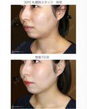 【30代女性・綺麗なフェイスライン】 before画像 サムネイル用
