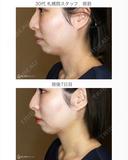 【30代女性・綺麗なフェイスライン】 7日後 サムネイル用