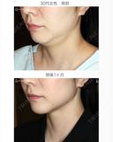 【30代女性・これだけで劇的変化】脂肪吸引注射 あご下（術直後〜1ヶ月後） before画像 サムネイル用