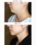 【30代女性・これだけで劇的変化】脂肪吸引注射 あご下（術直後〜1ヶ月後） 30日後 サムネイル用