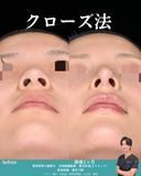クローズ法鼻整形 30日後 サムネイル用