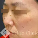 ホクロ・イボ取り【CO2レーザー】 before画像 サムネイル用