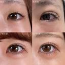 二重埋没法 after画像 サムネイル用