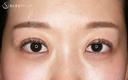 【20代女性・札幌院スタッフ】マイクロメソッド+α（術直後〜9日目） 1日後 サムネイル用