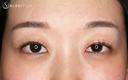 【20代女性・札幌院スタッフ】マイクロメソッド+α（術直後〜9日目） before画像 サムネイル用