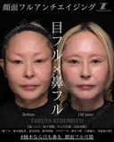 顔面フル　アンチエイジング before画像 サムネイル用