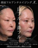 顔面フル　アンチエイジング 30日後 サムネイル用