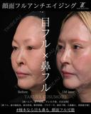 顔面フル　アンチエイジング 30日後 サムネイル用