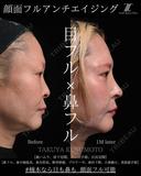 顔面フル　アンチエイジング 30日後 サムネイル用