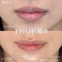 加賀デザイン×下唇口唇縮小 after画像 サムネイル用
