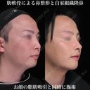 肋軟骨による鼻整形 180日後 サムネイル用