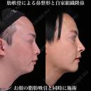 肋軟骨による鼻整形 180日後 サムネイル用