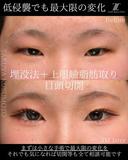 埋没法＋上眼瞼脂肪取り＋目頭切開 90日後 サムネイル用
