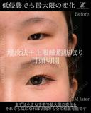 埋没法＋上眼瞼脂肪取り＋目頭切開 90日後 サムネイル用