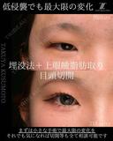 埋没法＋上眼瞼脂肪取り＋目頭切開 90日後 サムネイル用
