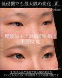 埋没法＋上眼瞼脂肪取り＋目頭切開 90日後 サムネイル用