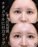 【タレ目尻切開】 before画像 サムネイル用