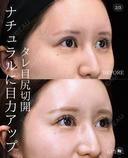 【タレ目尻切開】 30日後 サムネイル用