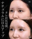 【タレ目尻切開】 30日後 サムネイル用