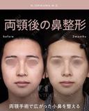 忘れ鼻整形 before画像 サムネイル用