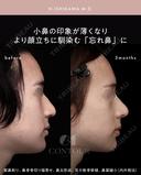 忘れ鼻整形 90日後 サムネイル用