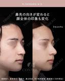 忘れ鼻整形 90日後 サムネイル用