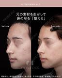忘れ鼻整形 90日後 サムネイル用