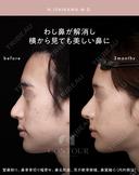 忘れ鼻整形 90日後 サムネイル用