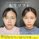 転生リフト before画像 サムネイル用