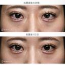【20代女性・涙袋ヒアルで目を大きく見せる】ヒアルロン酸レスチレン・リフトリド（注入直後〜1年後） 1日後 サムネイル用