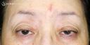 【60代女性・ハードコンタクトによる眼瞼下垂】切らない眼瞼下垂+α法（術直後〜2年後） before画像 サムネイル用