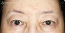 【60代女性・ハードコンタクトによる眼瞼下垂】切らない眼瞼下垂+α法（術直後〜2年後） 730日後 サムネイル用