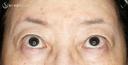 【60代女性・ハードコンタクトによる眼瞼下垂】切らない眼瞼下垂+α法（術直後〜2年後） 730日後 サムネイル用