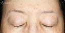 【60代女性・ハードコンタクトによる眼瞼下垂】切らない眼瞼下垂+α法（術直後〜2年後） 730日後 サムネイル用