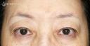 【60代女性・ハードコンタクトによる眼瞼下垂】切らない眼瞼下垂+α法（術直後〜2年後） 150日後 サムネイル用
