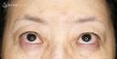 【60代女性・ハードコンタクトによる眼瞼下垂】切らない眼瞼下垂+α法（術直後〜2年後） 150日後 サムネイル用