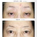 【60代女性・ハードコンタクトによる眼瞼下垂】切らない眼瞼下垂+α法（術直後〜2年後） 730日後 サムネイル用