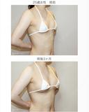 【25歳女性・繊維質の脂肪で吸引に苦労したケース】プレミアムセリューション豊胸術（3ヶ月後） after画像 サムネイル用