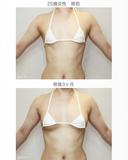 【25歳女性・繊維質の脂肪で吸引に苦労したケース】プレミアムセリューション豊胸術（3ヶ月後） after画像 サムネイル用