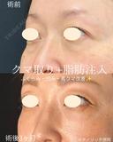 目の下のふくらみ取り+脂肪注入 before画像 サムネイル用