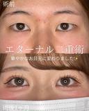 エターナル二重術 30日後 サムネイル用