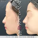 ツンとした美鼻に♡プロテーゼ+鼻尖形成3D法+軟骨移植 after画像 サムネイル用