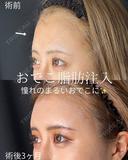おでこ脂肪注入 90日後 サムネイル用