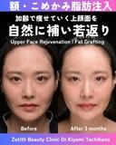 額・こめかみ脂肪注入 before画像 サムネイル用